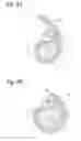 Fig. 04 - HYDRAULIC URETHRAL OCCLUSIVE DEVICE