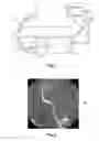 Fig. 02 - Automatic device-footprint-free roadmapping for endovascular interventions