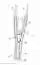 Fig. 04 - Septotomy catheter for aortic dissection