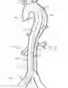 Fig. 06 - Septotomy catheter for aortic dissection