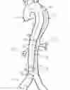 Fig. 07 - Septotomy catheter for aortic dissection