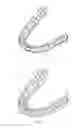 Fig. 02 - Primer aligner stages for lag issue resolution in low-stage clear aligner treatments