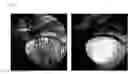Fig. 07 - MANAGEMENT OF TRACTIONAL MEMBRANES