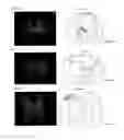 Fig. 04 - Methods and systems for treatment of spinal disorders using trans-spinal direct current stimulation