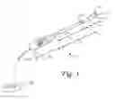 Fig. 02 - BLADDER DENERVATION FOR TREATING OVERACTIVE BLADDER