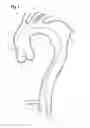 Fig. 02 - Stent graft delivery device pre-loaded with a single wire for device tracking and cannulation