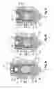 Fig. 04 - Locking assembly for a polyaxial bone anchoring device