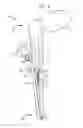 Fig. 02 - Instruments and methods for tensioning a spinal tether