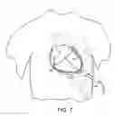 Fig. 07 - PERICARDIAL REINFORCEMENT DEVICE