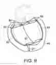 Fig. 09 - PERICARDIAL REINFORCEMENT DEVICE