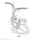 Fig. 06 - Cannula assembly for fitting a flow cannula for introducing, circulating or diverting flow media, and method for extracorporeal support of a patient with pulmonary hypertension or pulmonary insufficiency