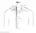 Fig. 09 - Central venous access system