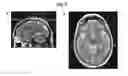 Fig. 09 - Methods and systems for treating neurological movement disorders