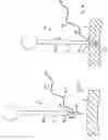 Fig. 33 - APPARATUS FOR INSERTING A SURGICAL DEVICE AT LEAST PARTIALLY THROUGH A WOUND OPENING