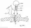 Fig. 99 - APPARATUS FOR INSERTING A SURGICAL DEVICE AT LEAST PARTIALLY THROUGH A WOUND OPENING