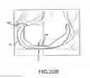 Fig. 49 - Preoperatively planning an arthroplasty procedure and generating a corresponding patient specific arthroplasty resection guide