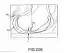 Fig. 49 - Preoperatively planning an arthroplasty procedure and generating a corresponding patient specific arthroplasty resection guide