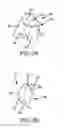 Fig. 08 - Preoperatively planning an arthroplasty procedure and generating a corresponding patient specific arthroplasty resection guide