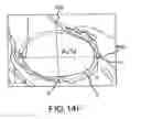 Fig. 32 - Preoperatively planning an arthroplasty procedure and generating a corresponding patient specific arthroplasty resection guide