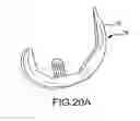 Fig. 41 - Preoperatively planning an arthroplasty procedure and generating a corresponding patient specific arthroplasty resection guide
