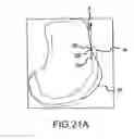 Fig. 44 - Preoperatively planning an arthroplasty procedure and generating a corresponding patient specific arthroplasty resection guide