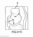 Fig. 46 - Preoperatively planning an arthroplasty procedure and generating a corresponding patient specific arthroplasty resection guide