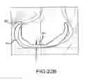Fig. 49 - Preoperatively planning an arthroplasty procedure and generating a corresponding patient specific arthroplasty resection guide