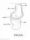 Fig. 74 - Preoperatively planning an arthroplasty procedure and generating a corresponding patient specific arthroplasty resection guide