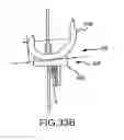 Fig. 75 - Preoperatively planning an arthroplasty procedure and generating a corresponding patient specific arthroplasty resection guide