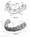 Fig. 07 - Dental framework and prosthesis