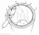 Fig. 01 - Chimney-graft stent