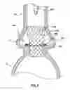 Fig. 09 - Valve prostheses having an integral centering mechanism and methods of use thereof