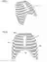 Fig. 02 - Thoracic prosthesis and its method of preparation