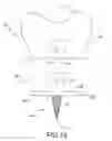 Fig. 09 - Long bone resurfacing bone lock