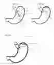 Fig. 07 - Magnetic satiety-inducing system