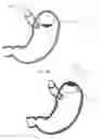 Fig. 08 - Magnetic satiety-inducing system