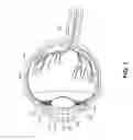 Fig. 02 - Method and apparatus for inserting an implant in the cornea of the eye
