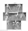 Fig. 30 - Use of stabilized granules containing glyceryl trinitrate for arteriogenesis