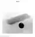 Fig. 49 - Patient-specific temporary implants for accurately guiding local means of tumor control along patient-specific internal channels to treat cancer