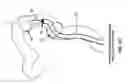 Fig. 85 - Method and apparatus for manipulating the side wall of a body lumen or body cavity so as to provide increased visualization of the same and/or increased access to the same, and/or for stabilizing instruments relative to the same