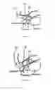 Fig. 02 - Endorectal prostate probe composed of a combined mini gamma camera and ultrasound sensor