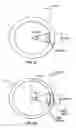 Fig. 20 - Procedures for vascular occlusion