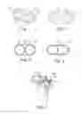 Fig. 02 - Multiple orifice implantable heart valve and methods of implantation