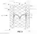Fig. 04 - Mitral heart valve replacement