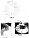 Fig. 09 - Mitral heart valve replacement