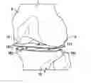 Fig. 01 - Balancing device for arthroplasty and methods for use