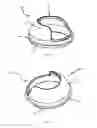 Fig. 02 - STOMA PROTECTIVE DEVICE