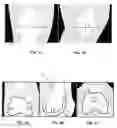 Fig. 02 - Method for constructing a patient-specific surgical guide