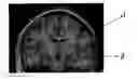 Fig. 01 - Method for establishing prediction model based on multidimensional texture of brain nuclear magnetic resonance images