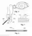 Fig. 02 - BIORESORBABLE, ENDOSCOPIC DCR STENT